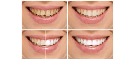 Top 3 Cosmetic Dentistry Options to Consider in Toronto