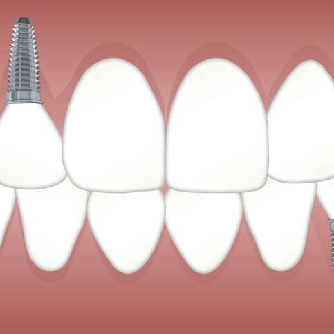 5 Ways to Prepare for Dental Implant Surgeries