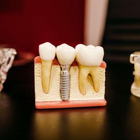 Crucial Steps Involved In Dental Implant Surgery