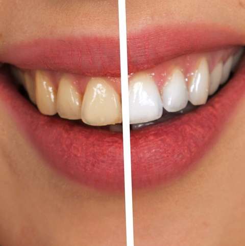 The Benefits of Getting Your Teeth Whitened by a Professional