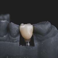 5 Dental Emergencies That Require Dental Implants