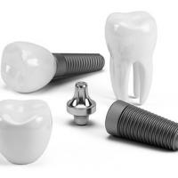 6 Amazing Benefits of Dental Implants