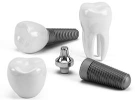 How To Take Care Of Your Dental Implants in Toronto