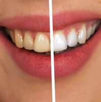 The Benefits of Getting Your Teeth Whitened by a Professional