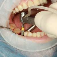Upcoming Dental Implant Procedure? Here’s What To Expect