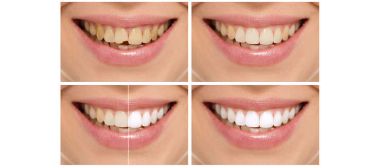 Top 3 Cosmetic Dentistry Options to Consider in Toronto