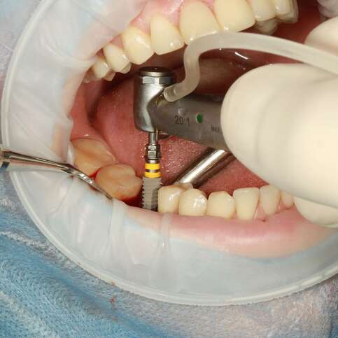 Traditional Dental Implants Procedure: A Step-by-Step Guide