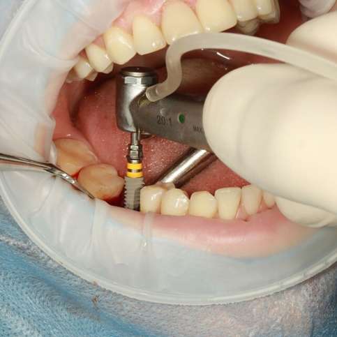 Upcoming Dental Implant Procedure? Here’s What To Expect