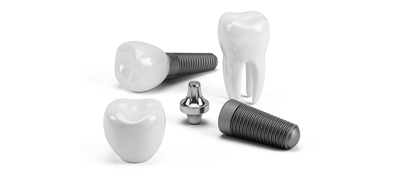 dental implants Toronto